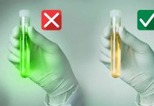 İdrarla prostat kanseri teşhisi!