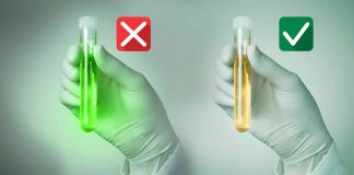 İdrarla prostat kanseri teşhisi!