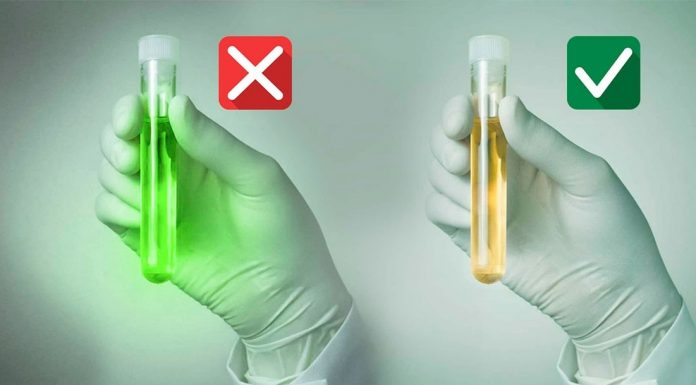 İdrarla prostat kanseri teşhisi!