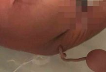Bir bebek, 12 cm uzunluğunda ‘insan kuyruğu’ ile dünyaya geldi