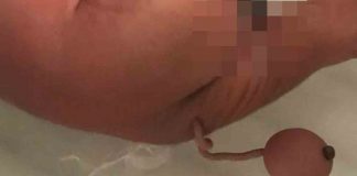 Bir bebek, 12 cm uzunluğunda ‘insan kuyruğu’ ile dünyaya geldi