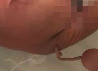 Bir bebek, 12 cm uzunluğunda ‘insan kuyruğu’ ile dünyaya geldi