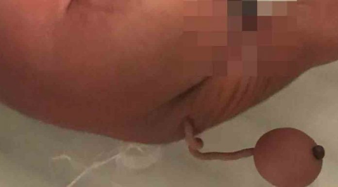 Bir bebek, 12 cm uzunluğunda ‘insan kuyruğu’ ile dünyaya geldi