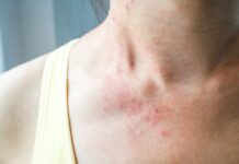 Uzmanlar uyardı: Cildinizde bu belirtiler varsa Omicron olabilir.