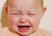 Dikkat… Kızamık vakaları bu yıl yüzde 80 artış gösterdi!