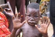 Maymun çiçeği virüsü hakkında neler biliniyor, yeni bir pandemi ihtimali var mı? Nasıl önlemler alınabilir? Aşısı var mı?