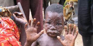 Maymun çiçeği virüsü hakkında neler biliniyor, yeni bir pandemi ihtimali var mı? Nasıl önlemler alınabilir? Aşısı var mı?