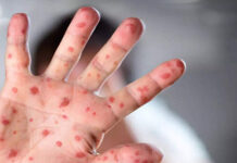 BAE’de ilk maymun çiçeği vakası tespit edildi