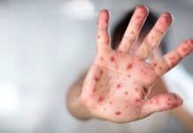 DSÖ alarm vererek duyurdu: Daha ölümcül olan M Çiçeği varyantı kontrolden çıkıyor!