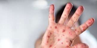 DSÖ alarm vererek duyurdu: Daha ölümcül olan M Çiçeği varyantı kontrolden çıkıyor!