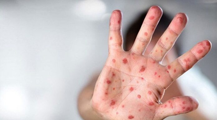 DSÖ alarm vererek duyurdu: Daha ölümcül olan M Çiçeği varyantı kontrolden çıkıyor!