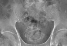 Böylesi ne görüldü, ne duyuldu; Adamın cinsel organından 2 metrelik atlama ipi çıktı