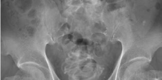 Böylesi ne görüldü, ne duyuldu; Adamın cinsel organından 2 metrelik atlama ipi çıktı