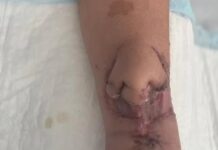 Tıp’ta çığır açan tedavi: Kanserden kaybettiği burnunun örneğini koluna naklettiler, ardından yüzüne