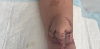 Tıp’ta çığır açan tedavi: Kanserden kaybettiği burnunun örneğini koluna naklettiler, ardından yüzüne