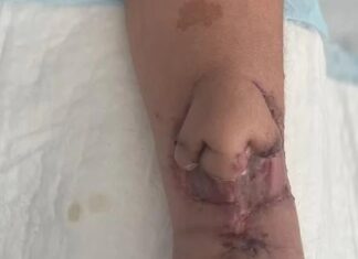 Tıp’ta çığır açan tedavi: Kanserden kaybettiği burnunun örneğini koluna naklettiler, ardından yüzüne
