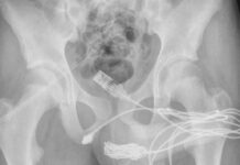 İngiltere’de 15 yaşındaki çocuk cinsel organında öyle bir şey denedi ki, tıp literatürüne girdi…