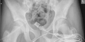 İngiltere’de 15 yaşındaki çocuk cinsel organında öyle bir şey denedi ki, tıp literatürüne girdi…