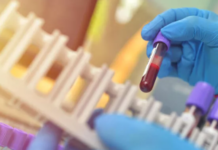 Bilim insanları, Alzheimer’ı teşhis eden kan testi geliştirdi