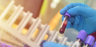 Bilim insanları, Alzheimer’ı teşhis eden kan testi geliştirdi