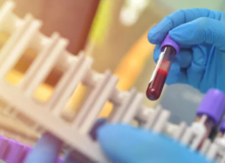 Bilim insanları, Alzheimer’ı teşhis eden kan testi geliştirdi