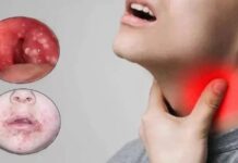 Bakan Koca, “Türkiye’de Strep A vakası görüldü, İlaç tedavisiyle 24 saat sonra bulaşıcılık artık söz konusu değil”