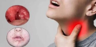 Bakan Koca, “Türkiye’de Strep A vakası görüldü, İlaç tedavisiyle 24 saat sonra bulaşıcılık artık söz konusu değil”