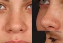 Burun ameliyatı ölüme götürdü; Kadın, ameliyat sonrası uyandırılamadı!