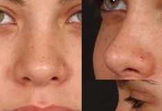 Burun ameliyatı ölüme götürdü; Kadın, ameliyat sonrası uyandırılamadı!