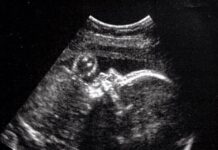 Dünyada bir ilk: Anne karnındayken beyin ameliyatı yapılan bir bebek kesin ölümden kurtarıldı.