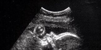 Dünyada bir ilk: Anne karnındayken beyin ameliyatı yapılan bir bebek kesin ölümden kurtarıldı.