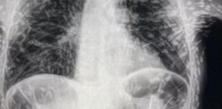 Tenya’ların bu kadar saldırgan olduğunu kim tahmin ederdi! Organları deldi geçti, beyne yumurtalarını bıraktı!