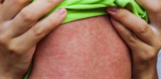 TÜRK TABİBLERİ BİRLİĞİ KIZAMIK SALGINI UYARISI YAPTI