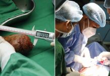 AKLA ZİYAN BİR BÖBREK TAŞI!