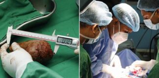 AKLA ZİYAN BİR BÖBREK TAŞI!