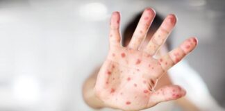 Kızamık vakalarının yüzde 86’sı İstanbul’da!