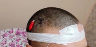 Kafasını matkapla delen adamın amacı akla ziyan; Rüyalarını kontrol edebilmek!