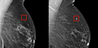 Yapay zeka meme kanserini radyologlar kadar etkili bir şekilde tespit edebiliyor. ,