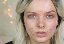 Özellikle gençlerin kabusu sivilcelerin bir numaralı nedeni kötü karbonhidratlar!