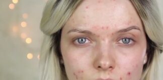 Özellikle gençlerin kabusu sivilcelerin bir numaralı nedeni kötü karbonhidratlar!