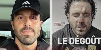 Avrupa’nın göbeğinde futbola kan bulaştı. Saldırıya uğrayan Lyon Teknik Direktörü Fabio Grosso’ya 13 dikiş atıldı!