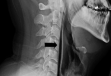 Bir İngilizin hapşırığını tutmaya çalışması nefes borusunda delik açılmasına neden oldu.