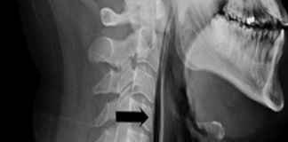 Bir İngilizin hapşırığını tutmaya çalışması nefes borusunda delik açılmasına neden oldu.
