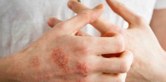 ABD’li bilim insanları kaşıma dürtüsünden staphylococcus aureus’un sorumlu olduğunu buldu