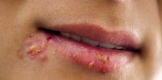 Uçuklara yatkın kişilerde demans riskinin iki kat daha fazla olabileceği öne sürüldü.