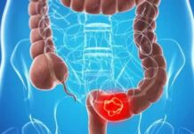 Uzmanlardan endişe verici kolon kanseri açıklaması. Genç insanlarda hiç olmadığı kadar çok görülecek