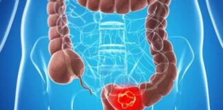 Uzmanlardan endişe verici kolon kanseri açıklaması. Genç insanlarda hiç olmadığı kadar çok görülecek