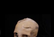 Antik Mısır’da 4.000 yıl önce kanseri ortadan kaldırmak için beyin ameliyatı denenmiş.