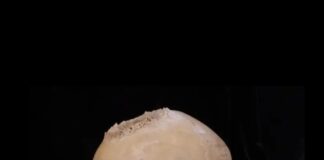 Antik Mısır’da 4.000 yıl önce kanseri ortadan kaldırmak için beyin ameliyatı denenmiş.