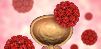 Tükürük testi ile erken prostat kanseri teşhisi!